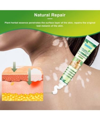 Picture of Vitiligo Treatment Cream Healthy White Spot Therapeutic Gel