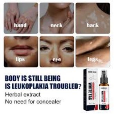 Picture of South Moon Vitiligo Treatment Spray Moisturizing Reduces White Spots Leukoplakia Disease Pigment Melanin Repair White Tag Care-30ml
