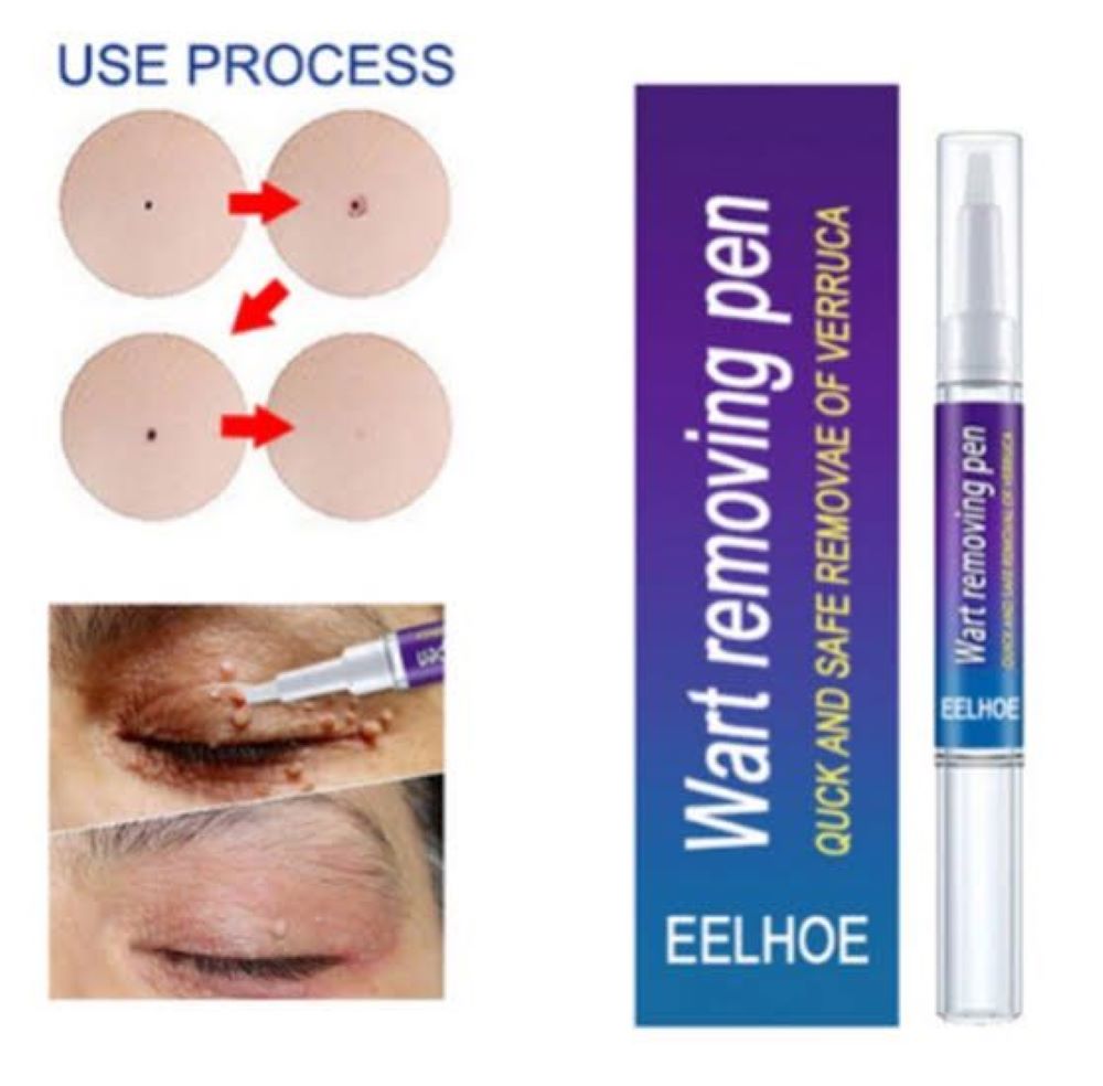 Picture of Eelhoe Doctor Proven Verruca & Wart Removing Pen