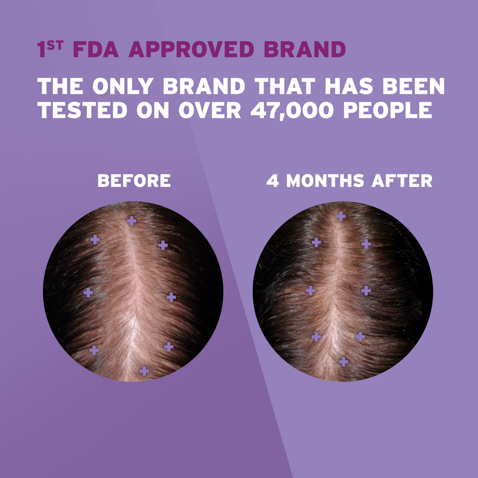 Picture of Female Minoxidil Rogaine Topical Solution Hair Regrowth Treatment 2% Minoxidil for Women - 60 ml 30 Days Supply with Derma Roller Combo