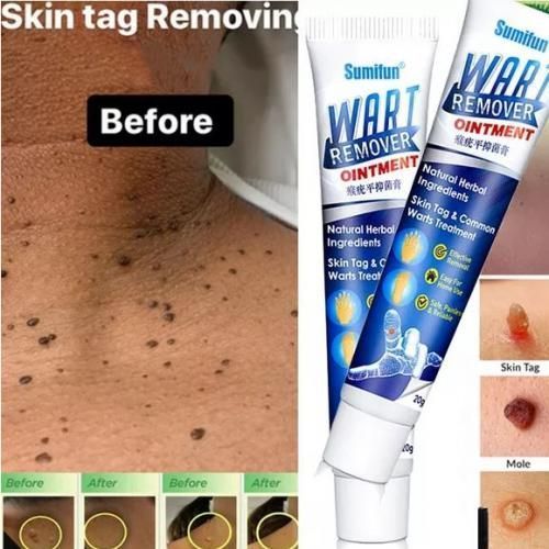 Picture of Warts & Skin Tag Remover Ointment: Treatment Cream