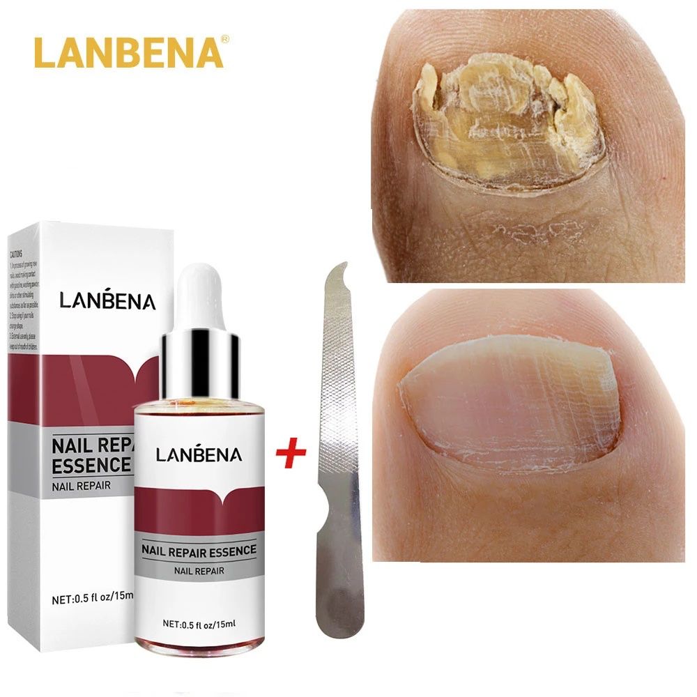 Picture of Lanbena Nail Repair Essence is used to treat and repair damaged or infected nails