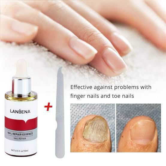 Picture of Lanbena Nail Repair Essence is used to treat and repair damaged or infected nails