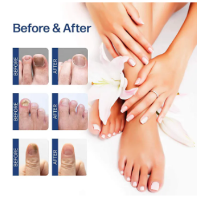 Picture of Repair Nail Fungus Treatment Serum Toe Fungal Repair Products Hand Foot Care Removal Gel Anti Infection Onychomycosis Paronychia