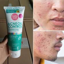 Picture of Cathy Doll Acne Oil Control Cleansing Foam-150ml
