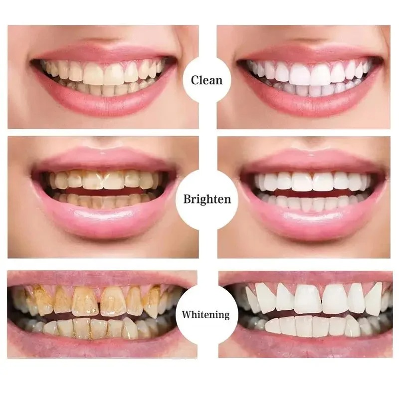 Picture of ELHOE Teeth Whitening Toothpaste – 100% Natural Herbal Formula – Instantly Whitens Teeth, Removes Yellow Stains, Fights Plaque & Bad Breath – Strengthens Enamel – Fluoride-Free & Safe for Sensitive Gums – Daily Oral Care Toothpaste for Men & Women