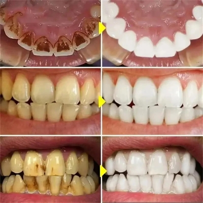 Picture of ELHOE Teeth Whitening Toothpaste – 100% Natural Herbal Formula – Instantly Whitens Teeth, Removes Yellow Stains, Fights Plaque & Bad Breath – Strengthens Enamel – Fluoride-Free & Safe for Sensitive Gums – Daily Oral Care Toothpaste for Men & Women