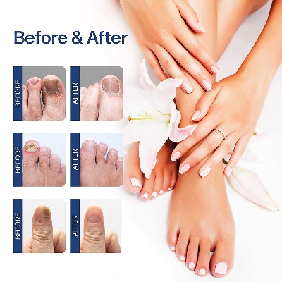 Picture of Repair Nail Fungus Treatment Serum Toe Fungal Repair Products Hand Foot Care Removal Gel Anti Infection Onychomycosis Paronychia