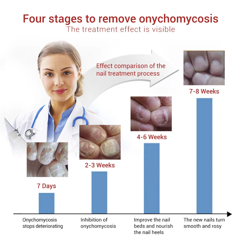 Picture of Repair Nail Fungus Treatment Serum Toe Fungal Repair Products Hand Foot Care Removal Gel Anti Infection Onychomycosis Paronychia