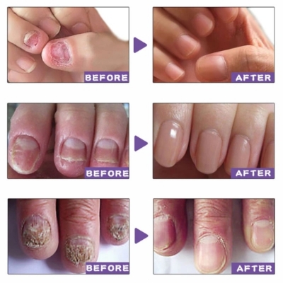 Picture of EELHOE Makes Your Nail Clean EELHOE Nail Repair Serum Nail Repair Oil 15ML