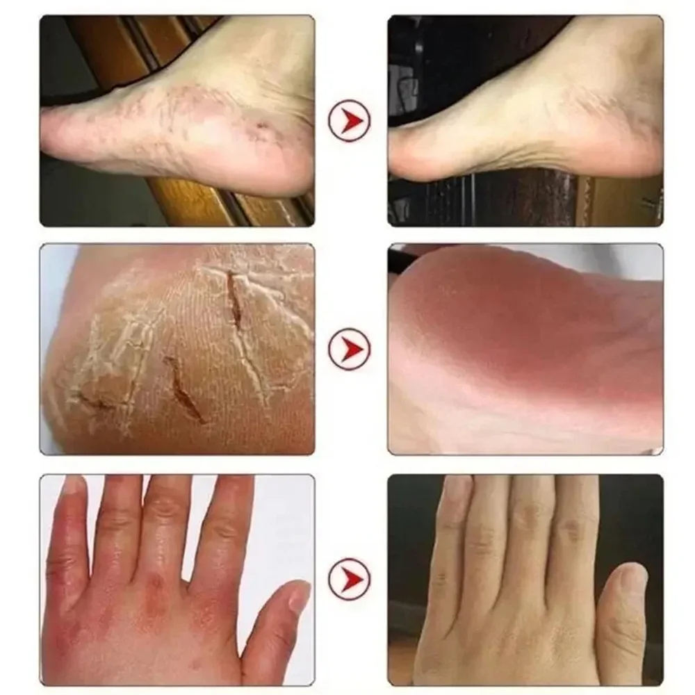 Picture of EELHOE Anti Crack Foot Hand Gel Ginger  Cuticles Care Anti-Drying Healing Crack Frost Mask Dead Skin Removal Deep Moisturizing Feet Crack Whitening Smooth Feet Care