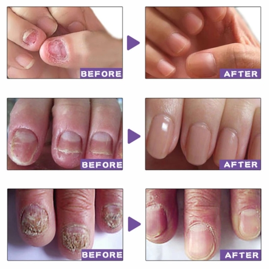 Picture of EELHOE Makes Your Nail Clean EELHOE Nail Repair Serum Nail Repair Oil 15ML