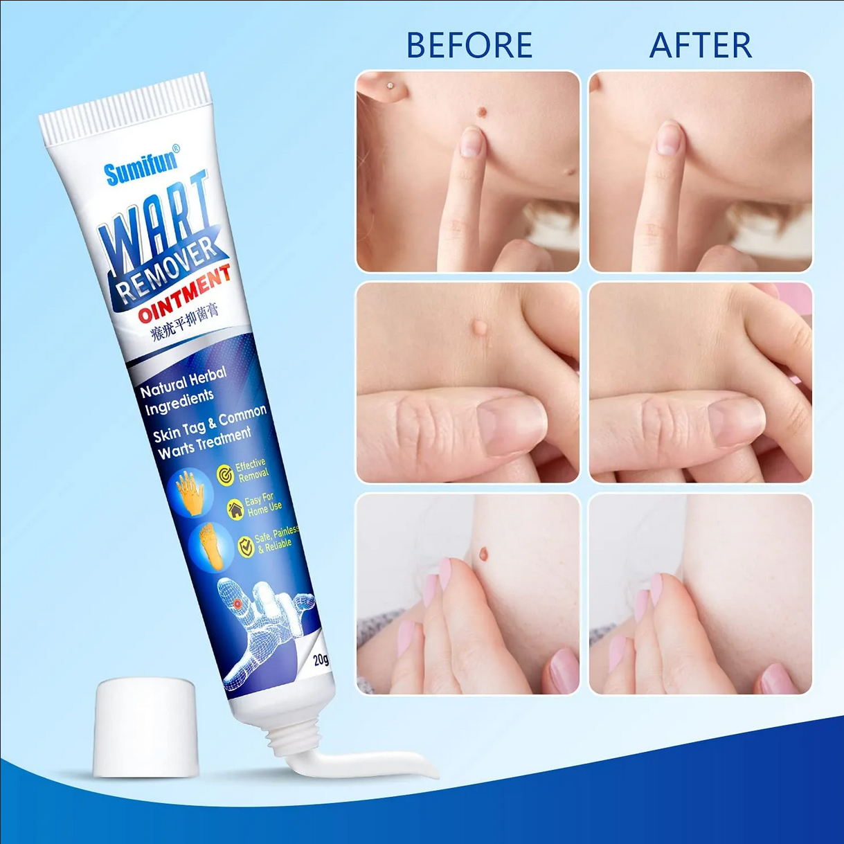 Picture of Sumifun Wart Remover Ointment 20g