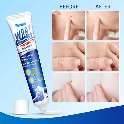 Picture of Sumifun Wart Remover Ointment 20g