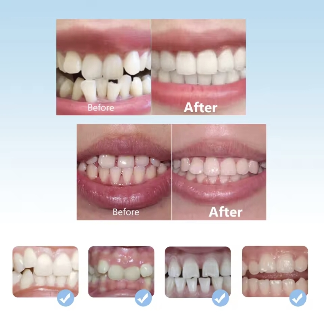 Picture of Orthodontic Retainers Braces 3-Stage Teeth Straightening Trainer for Different Tooth Alignments Multi-Purpose Oral Hygiene