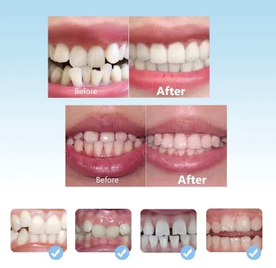 Picture of Orthodontic Retainers Braces 3-Stage Teeth Straightening Trainer for Different Tooth Alignments Multi-Purpose Oral Hygiene
