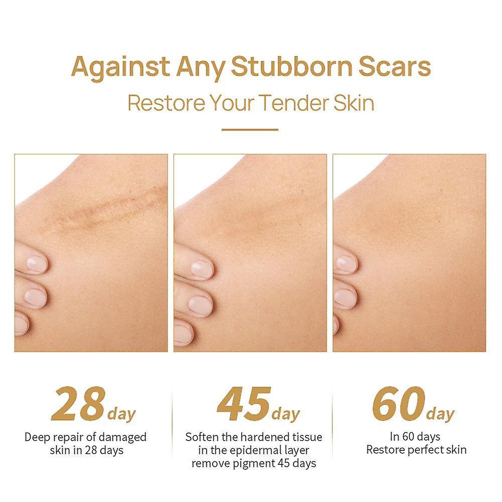 Picture of LanBeNa - TCM Acne Scar Removal Cream Skin Repair Face Cream for Burns Cuts Operation Stretch Mark Remover Acne Scar Treatment-30gm