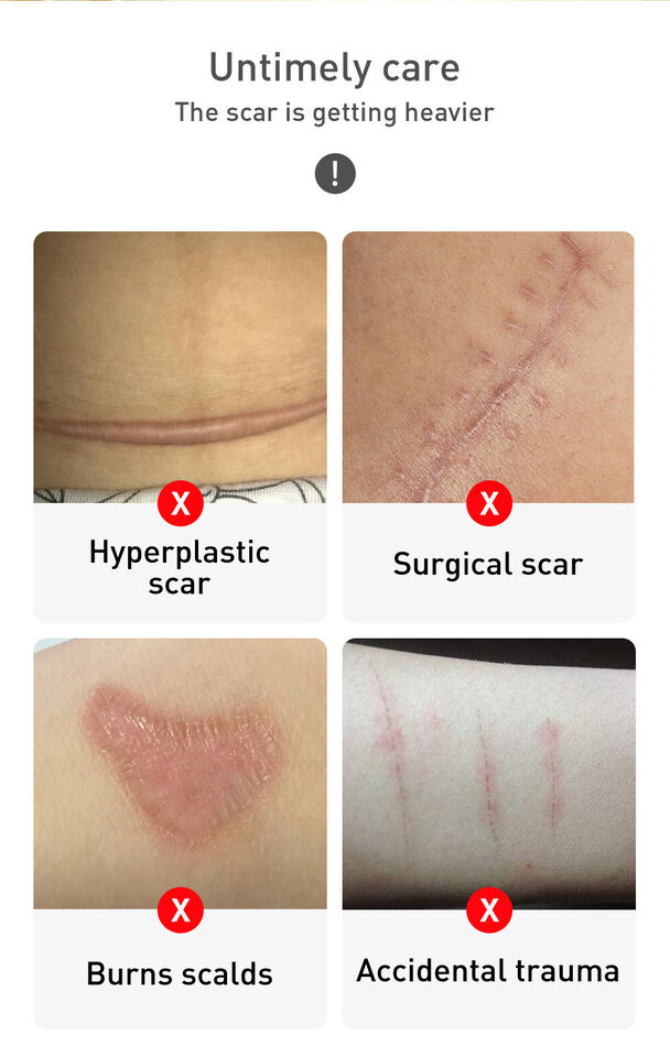 Picture of TCM -scar and acne mark removal gel ointment-30gm