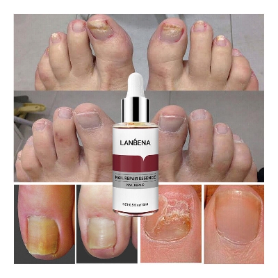 Picture of Lanbena Nail Fungal Treatment Remove Paronychia Onychomycosis Toe Nail Repairing,Treatment Toe Nail Repair Essence Nail Solution-15Ml
