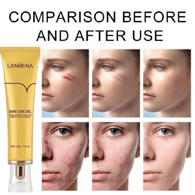 Picture of LanBeNa - TCM SCAR AND ACNE MARK REMOVAL GEL OINTMENT (30g) Acne Scar Cream