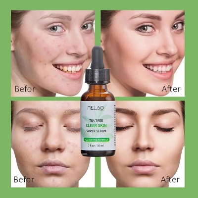 Picture of MELAO Natural Tea Tree Liquid Face Acne Essence Oil Control Serum -30ML