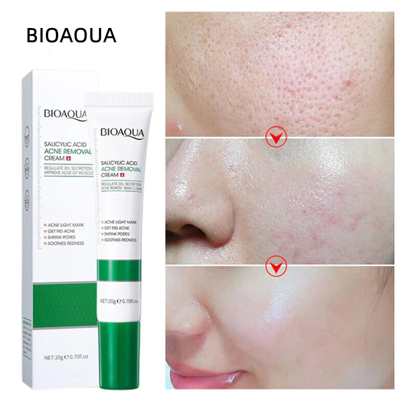 Picture of BIOAQUA Acne Removal Cream Anti Acne Treatment Repair Marks Moisturizing Blackhead Remover Facial Cream Skin Care-20gm