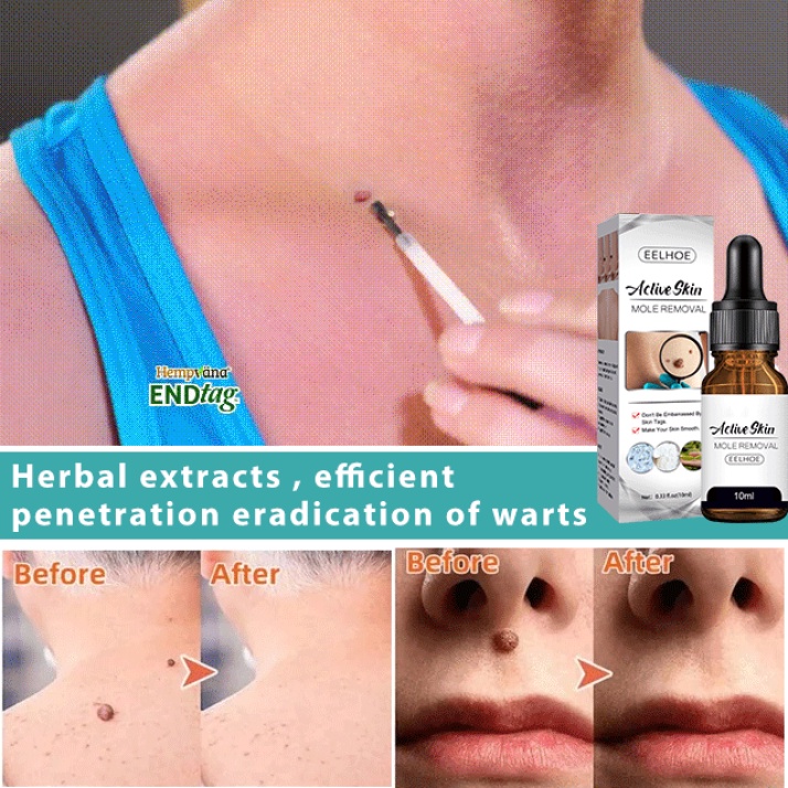 Picture of Eelhoe Active Skin Mole Reduce Serum Spot Removing Essence Face Mole Removal Repair Barrier Fix Facial Blemish Smooth Skin-10ml