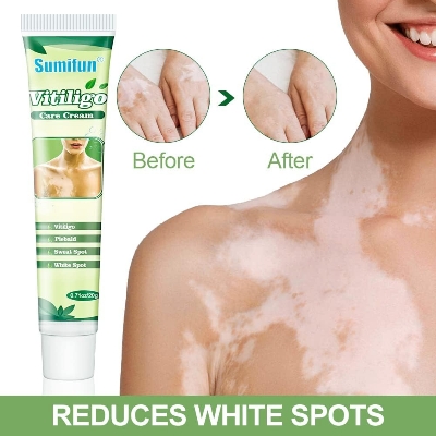 Picture of Sumifun Vitiligo Cream, Vitiligo Care Cream for Skin Vitiligo, Psoriasis, Leukoplakia - Reduces White Spots on Skin, Pigmentation regulating and Improve Skin Pigmentation - 1 Counts