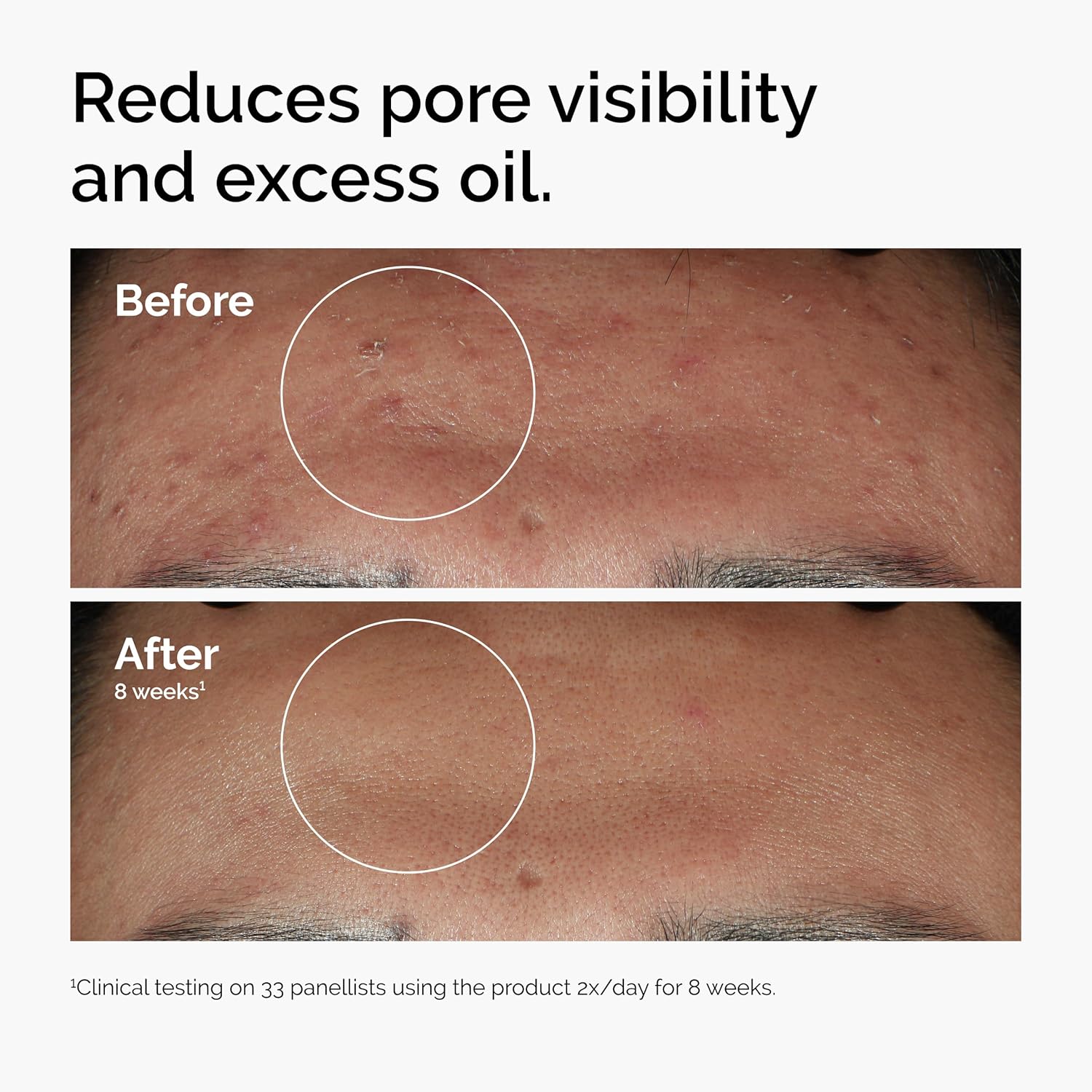 Picture of The Ordinary Niacinamide 10% + Zinc 1%, Smoothing Serum for Blemish-Prone Skin-30 ml