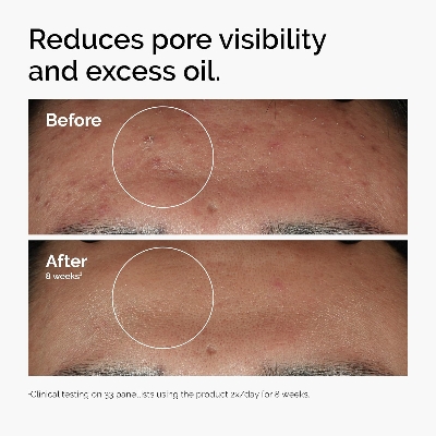 Picture of The Ordinary Niacinamide 10% + Zinc 1%, Smoothing Serum for Blemish-Prone Skin-30 ml