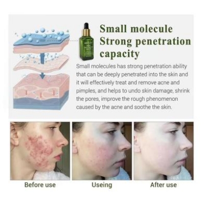 Picture of BREY_LEE Acne Treatment Serum 17ml