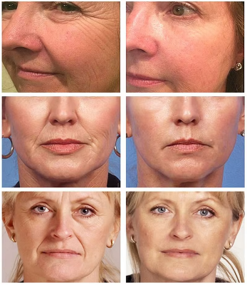 Picture of LAIKOU Blueberry Facial Serum Moisturing Skin Hydrating Repair Skin Improve Roughness Smoothing