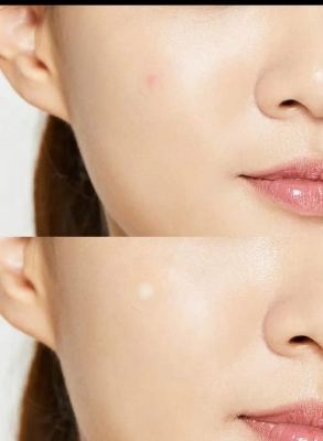 Picture of International Korean Product Cosrx Acne Pimple Master 24 Patches