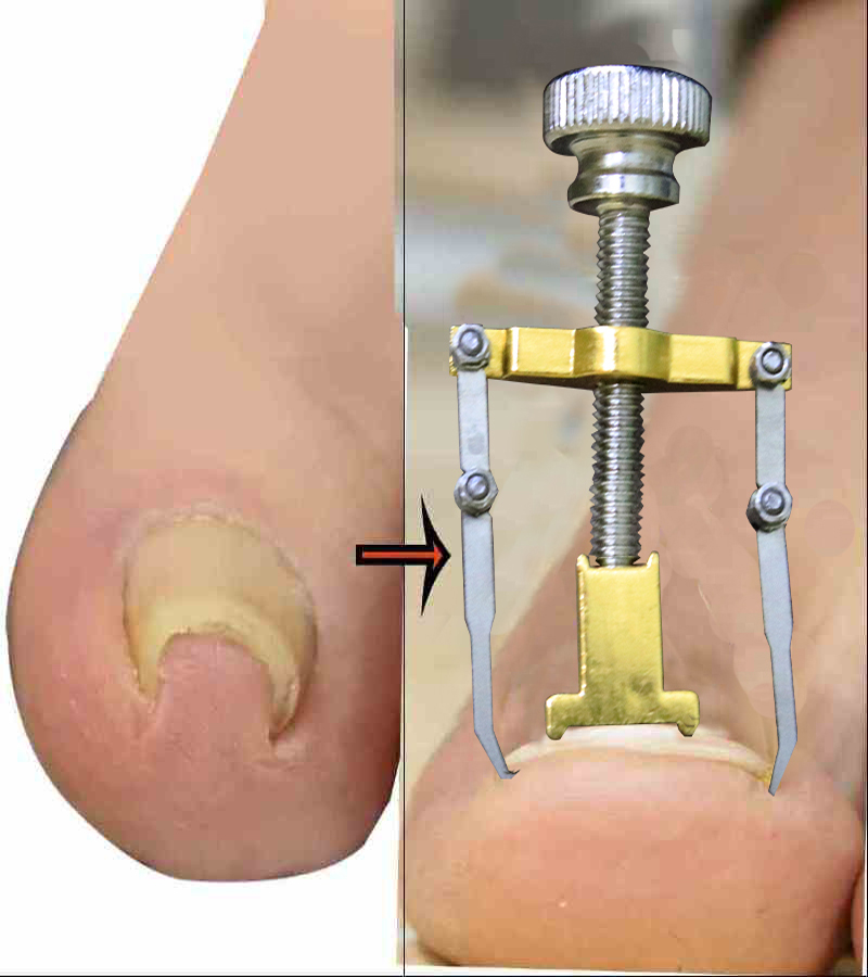 নখের কোনা সোজা করার অত্যাধুনিক যন্ত্র ( Nail Repair ZangCart Bdonline shop bangladeshothoba.com