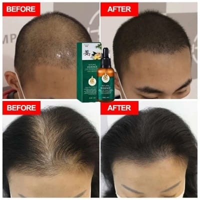 Picture of 100% Natural Ginger Hair Serum Hair Grower Fast Long Hair Treatment Minoxidil Hair Grower Castor Oil For Essence Preventing Baldness Consolidate Hair Loss Treatment repairs the hair improves hair loss hair growth serum 10 x faster