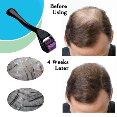 Picture of Derma Roller (0.5 mm) Professional Titanium Microneedle Derma Roller Hair Regrowth Acne Scars Anti-aging Skin Therapy Dermatology System