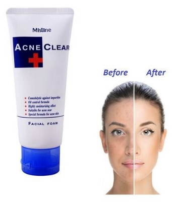 Picture of Face Wash Mistune Acne Clear Facial Foam Face Wash - 85Gm (Made In Thailand) - Face Wash