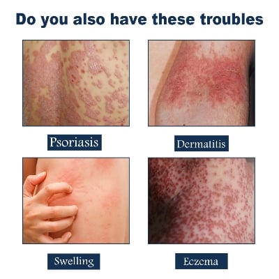 Picture of South Moon Psoriasis Relief Spray Net: 30ml