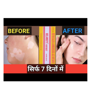 Picture of Indian Melanocyl Ointment  25g