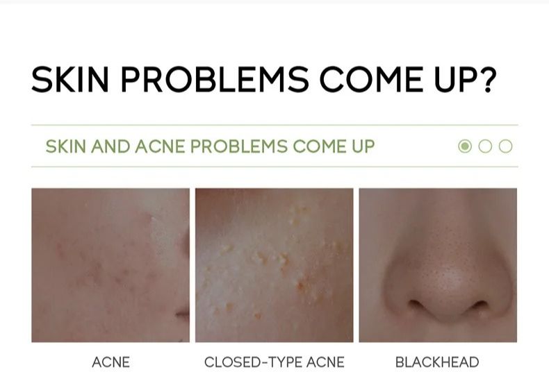 Picture of Fenyi 5% Mandelic Acid Anti Acne Serum- 17ml - 