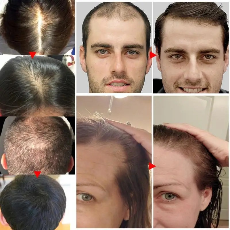 Picture of Rosemary Hair Growth Oil Ginger Anti Hair Loss Products Boost Hair Growing Serum Prevent Dry Frizz Damaged Scalp Repair Care