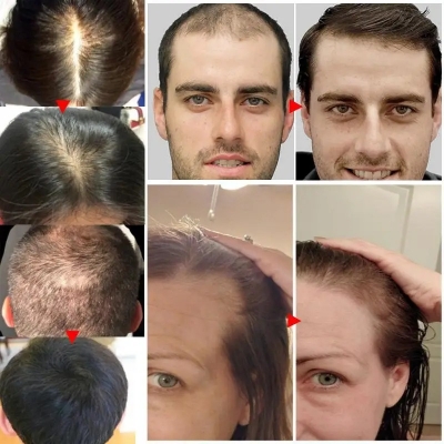 Picture of Rosemary Hair Growth Oil Ginger Anti Hair Loss Products Boost Hair Growing Serum Prevent Dry Frizz Damaged Scalp Repair Care