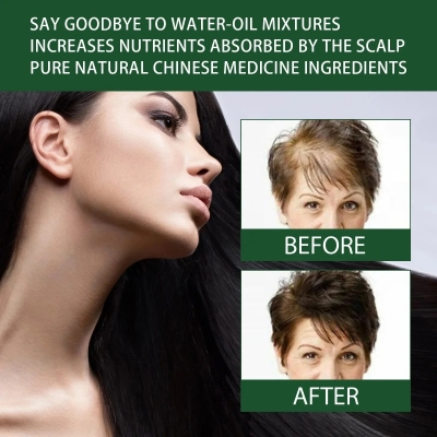 Picture of Rosemary Hair Growth Oil Ginger Anti Hair Loss Products Boost Hair Growing Serum Prevent Dry Frizz Damaged Scalp Repair Care