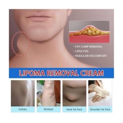 Picture of South Moon Lipoma Removal Cream Lipolysis Fat Lump Relieve Plaster Skin Swelling Ointment Subcutaneous Lumps Dredge Dissipate Body Care