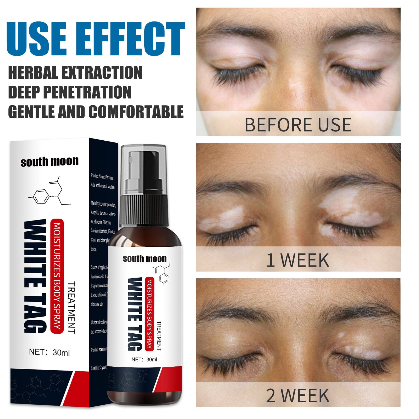 Picture of South Moon White Tag Treatment Spray Herbal Antibacterial Vitiligo Treatment Serum Leukoplakia Disease Pigment Melanin Repair Body Face Care（30ml）