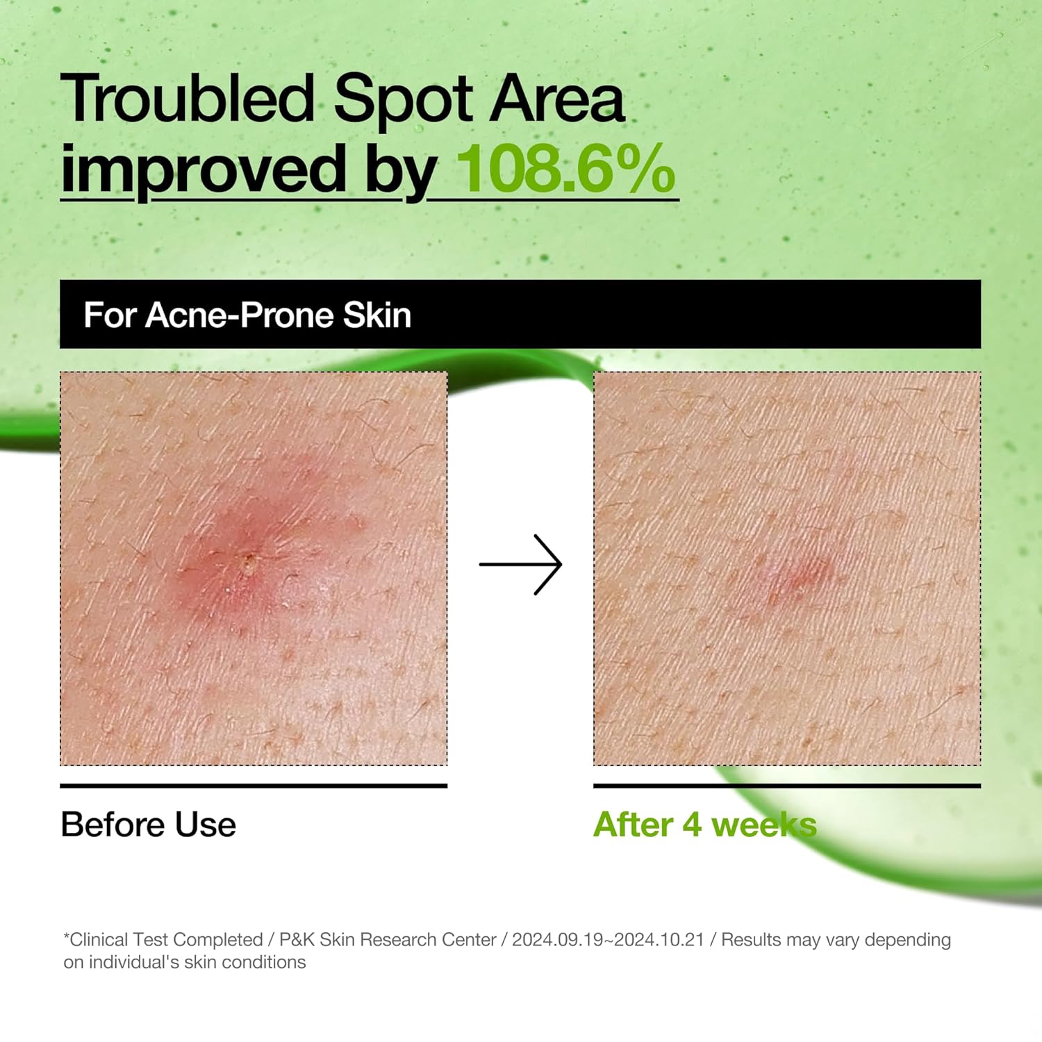 Picture of Anua Azelaic Acid 10 + Hyaluron Redness Soothing Serum – Lightweight Calming Formula for Sensitive & Irritated Skin, 30ml
