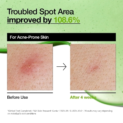 Picture of Anua Azelaic Acid 10 + Hyaluron Redness Soothing Serum – Lightweight Calming Formula for Sensitive & Irritated Skin, 30ml