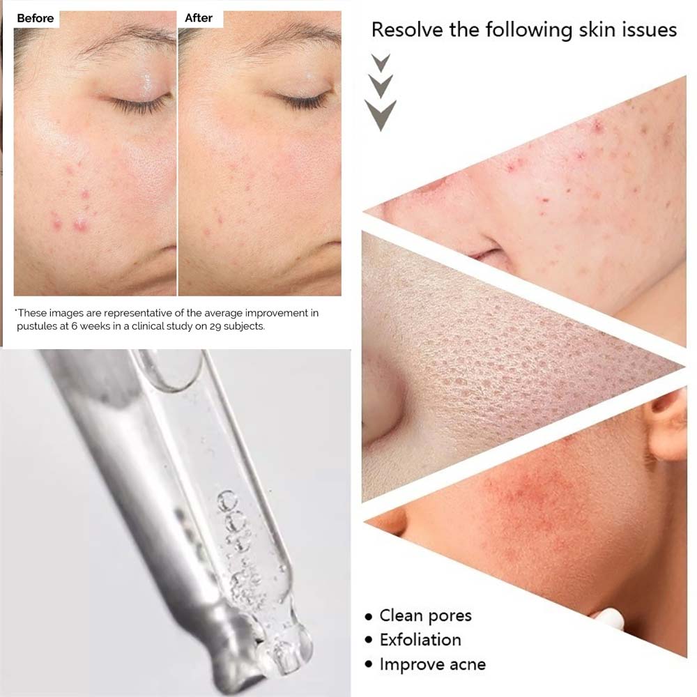 Picture of Salicylic Acid 2% Solution – 30ml
