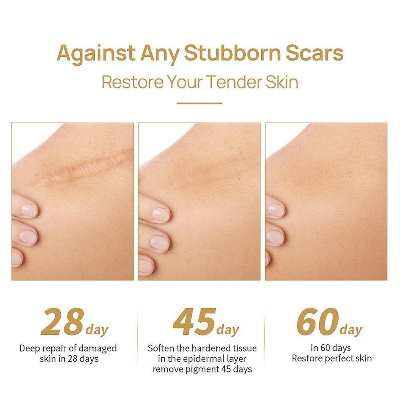 Picture of LanBeNa - TCM Acne Scar Removal Cream Skin Repair Face Cream for Burns Cuts Operation Stretch Mark Remover Acne Scar Treatment-30gm