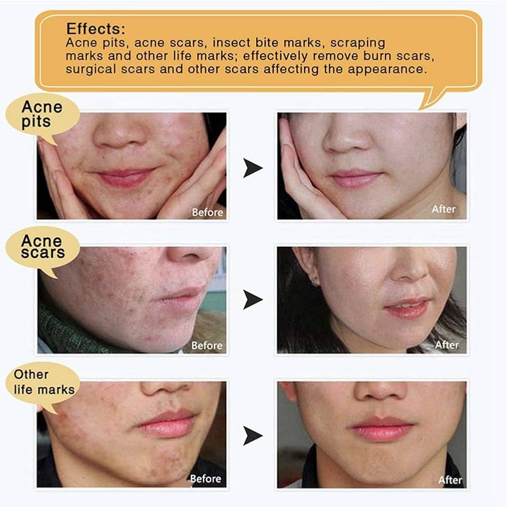 Picture of LanBeNa - TCM Acne Scar Removal Cream Skin Repair Face Cream for Burns Cuts Operation Stretch Mark Remover Acne Scar Treatment-30gm